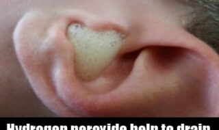 Hydrogen-peroxide-ear-treatment
